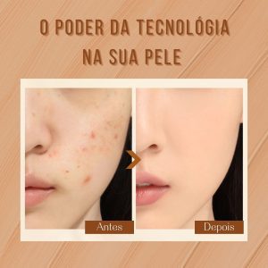 pele, acne, antes e depois, mulher