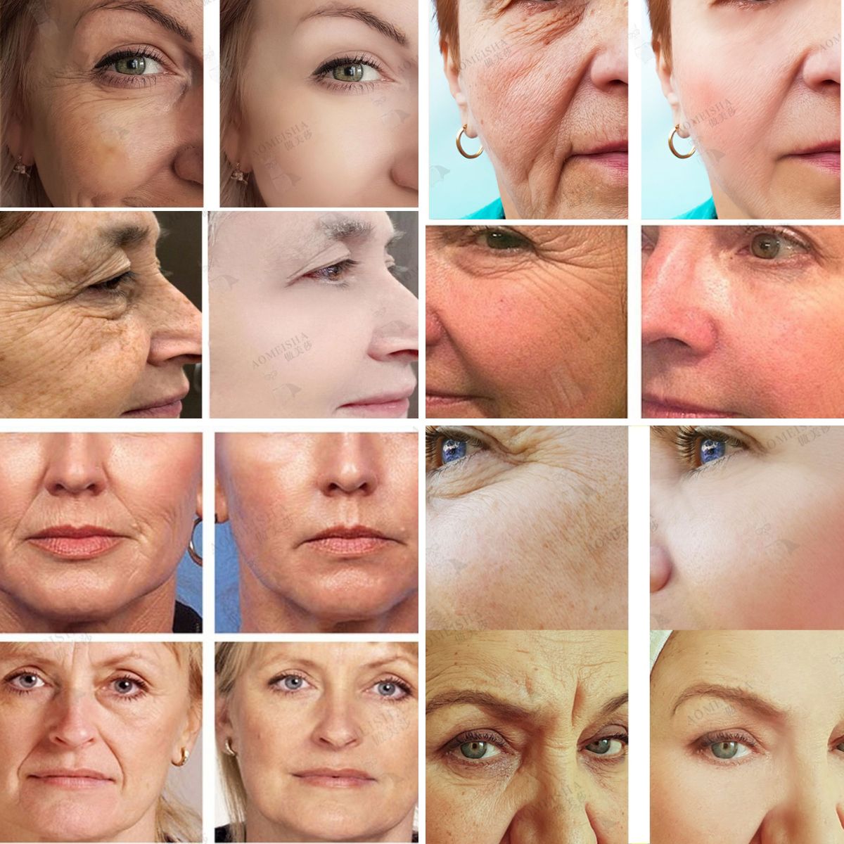 lifting facial, antienvelhecimento, antiaging, antiidade, rugas, linhas de expressão, skincare, cuidados com a pele, sérum